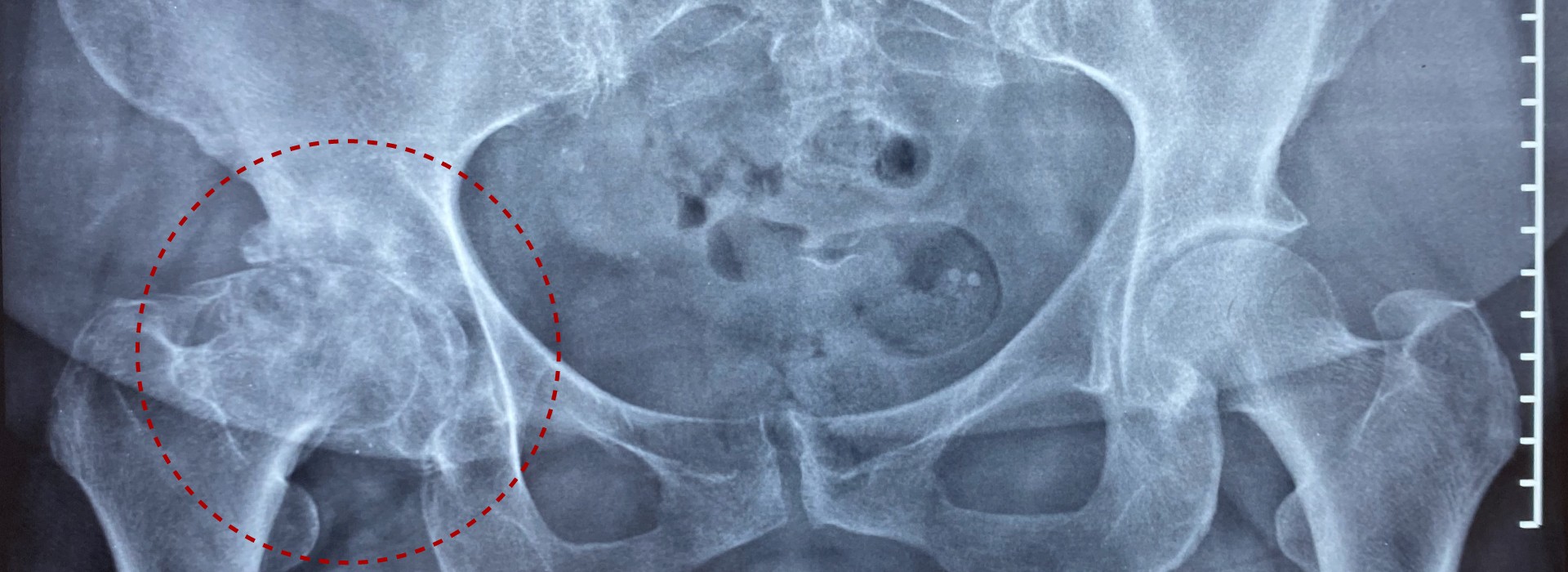 Osteoartritis de cadera: