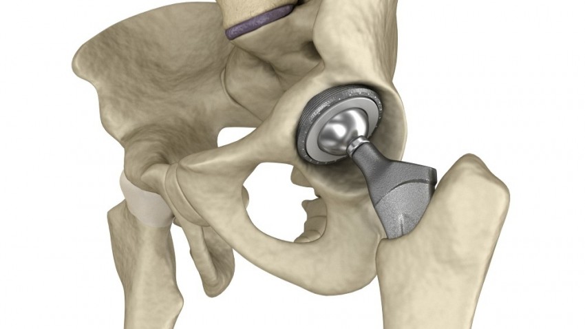 ¿Mi prótesis está fallando?: Cuándo hacer una cirugía de revisión es necesario