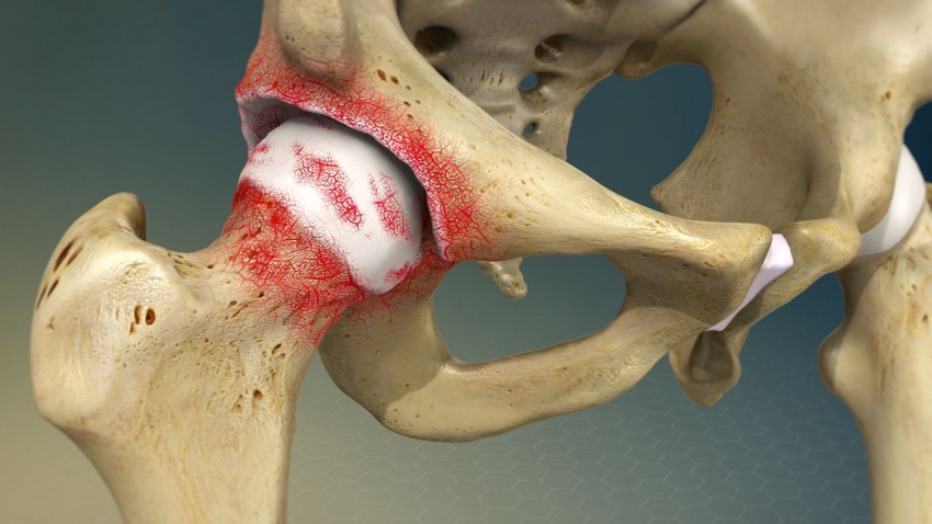 Osteoartrosis de cadera: Una enfermedad progresiva y dolorosa.