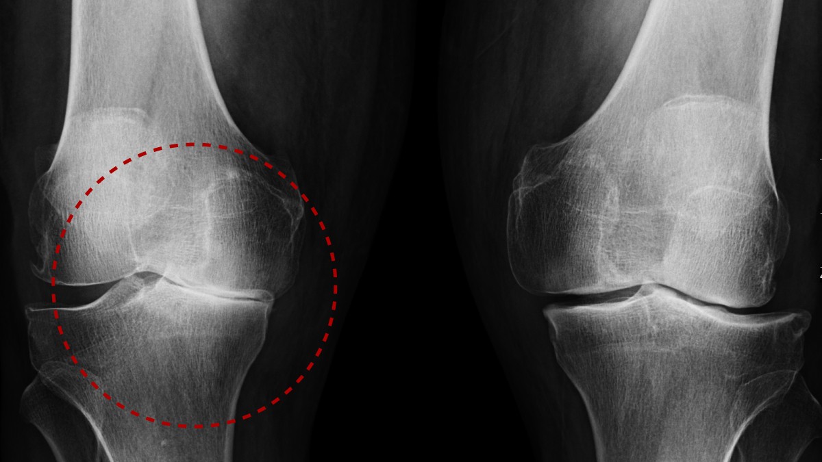 Radiografía de osteoartritis de la rodilla