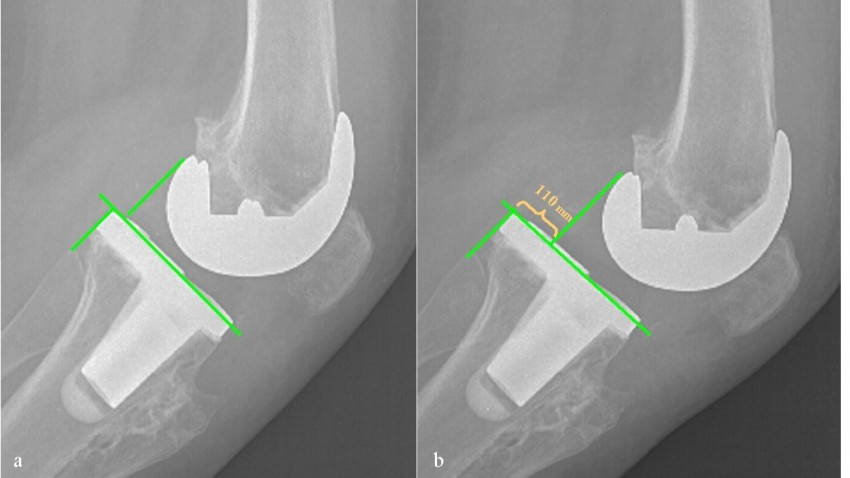 Knee prosthesis loosening