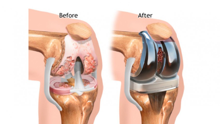 Artroplastia de rodilla