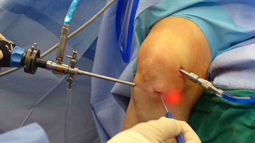Artroscopia de rodilla