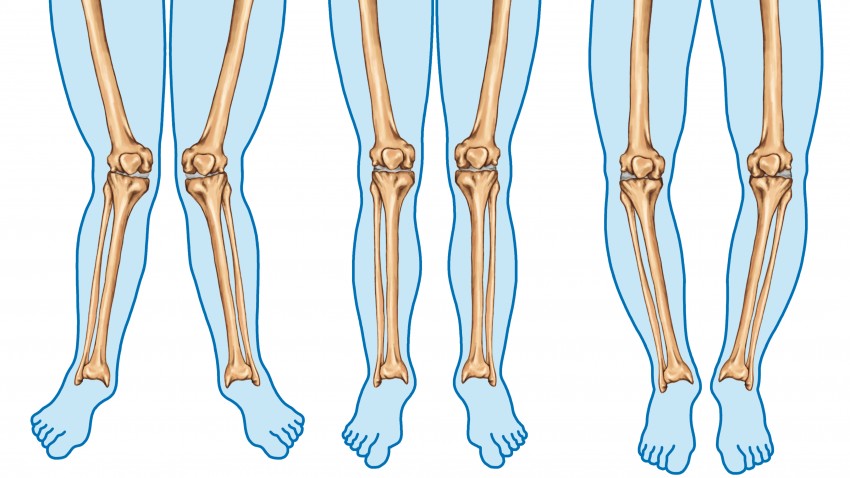 Deformidades en la rodilla