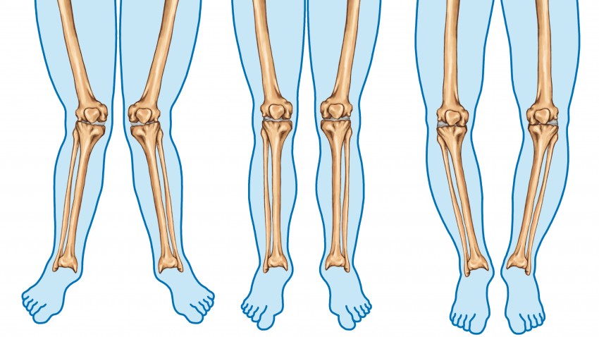 Knee deformities