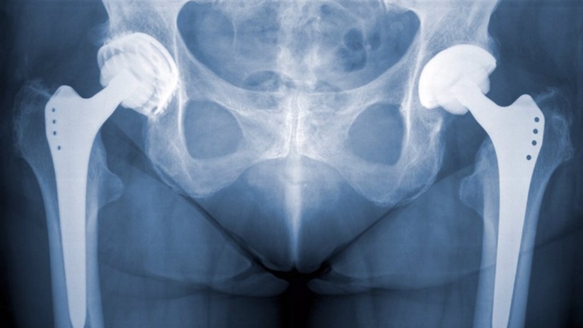 Hip replacement failure