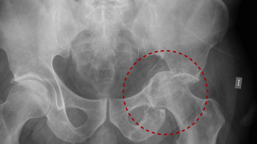 Acetabulum fracture