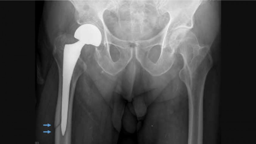  Periprosthetic hip fracture