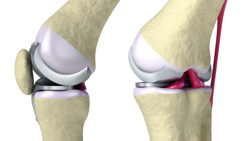 Fractura periprotésica en rodilla