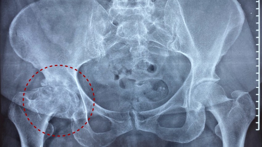 Osteoartritis de Cadera