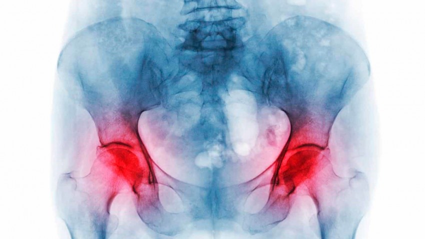 Osteonecrosis of the head of the femur