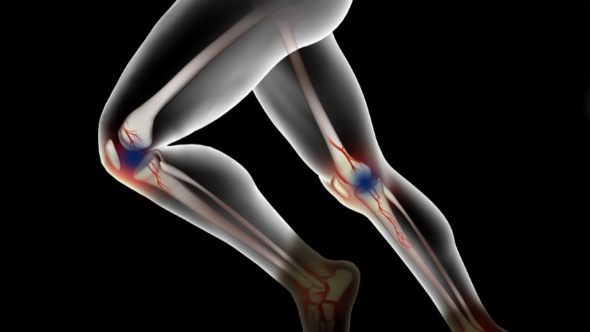 Osteonecrosis of the knee