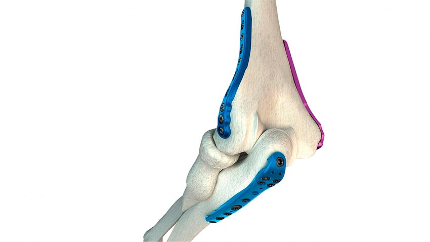 Osteosíntesis de rodilla