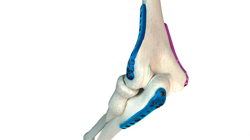 Knee osteosynthesis