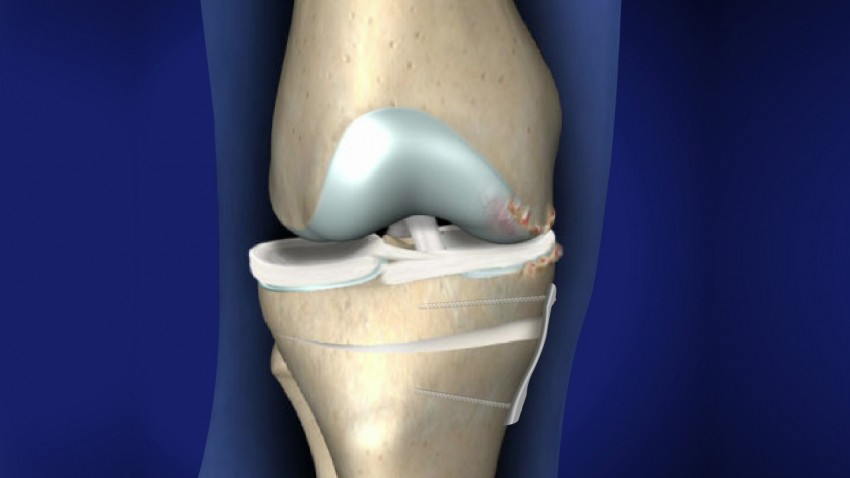 Osteotomía de rodilla