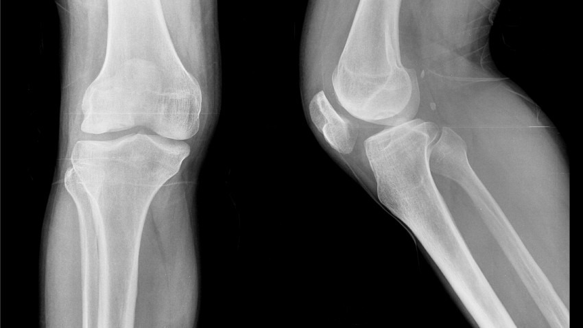 Pseudoarthrosis in knee