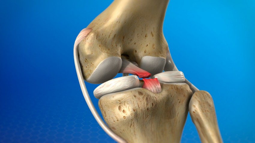 Ruptura de Ligamento Cruzado Posterior