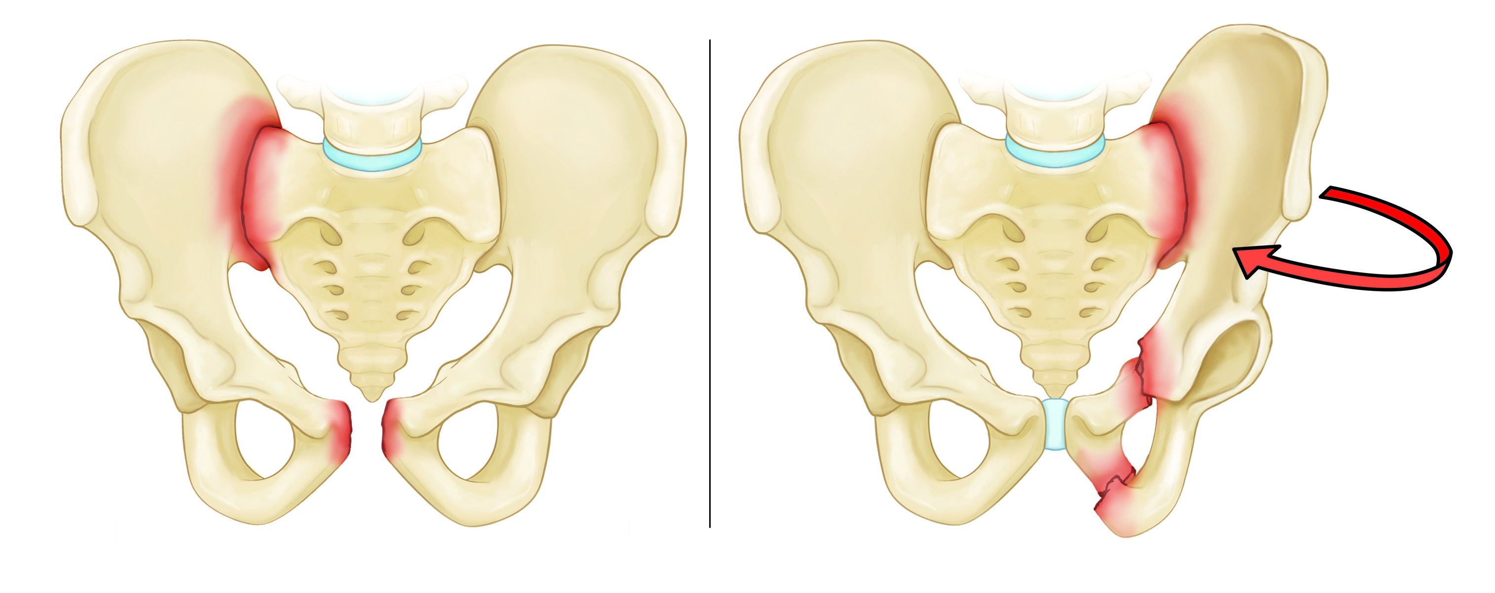 Types of Pelvis Fractures | Carrothers Orthopaedics